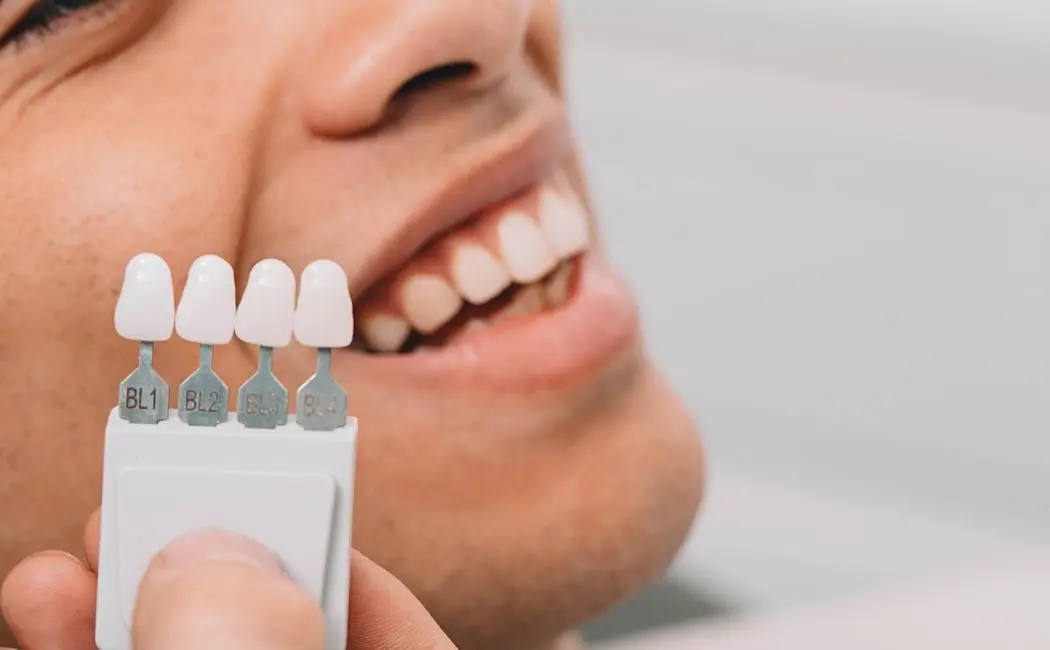 Ile kosztują licówki na zęby?